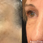 Source: Dr. Moubayed’s practice. Not a guarantee of results. Photos published with informed written consent of patients Female treated with Morpheus8