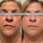 Source: Dr. Moubayed’s practice. Not a guarantee of results. Photos published with informed written consent of patients Female treated with Morpheus8