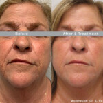 Source: Dr. Moubayed’s practice. Not a guarantee of results. Photos published with informed written consent of patients Female treated with Morpheus8
