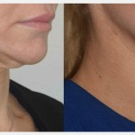 Source: Dr. Moubayed’s practice. Not a guarantee of results. Photos published with informed written consent of patients Female treated with Morpheus8
