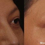 Source: Dr. Moubayed’s practice. Not a guarantee of results. Photos published with informed written consent of patients Female treated with Morpheus8