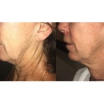 Source: Dr. Moubayed’s practice. Not a guarantee of results. Photos published with informed written consent of patients Female treated with Morpheus8