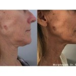 Source: Dr. Moubayed’s practice. Not a guarantee of results. Photos published with informed written consent of patients Female treated with Morpheus8