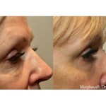 Source: Dr. Moubayed’s practice. Not a guarantee of results. Photos published with informed written consent of patients Female treated with Morpheus8