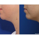 Source: Dr. Moubayed’s practice. Not a guarantee of results. Photos published with informed written consent of patients Female treated with Morpheus8