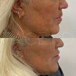 Facial rejuvination with fillers in the nasolabial folds as well as subtle lip enhancement