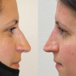 Source: Dr. Moubayed’s practice. Not a guarantee of results. Photos published with informed written consent of patients Female treated with non surgical nose job