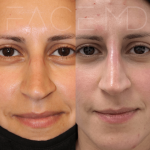 Source: Dr. Moubayed’s practice. Not a guarantee of results. Photos published with informed written consent of patients Female treated with non surgical nose job