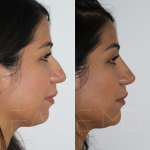 Source: Dr. Moubayed’s practice. Not a guarantee of results. Photos published with informed written consent of patients Female treated with non surgical nose job