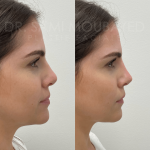 Source: Dr. Moubayed’s practice. Not a guarantee of results. Photos published with informed written consent of patients Female treated with non surgical nose job