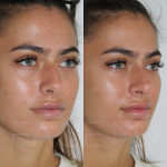 Source: Dr. Moubayed’s practice. Not a guarantee of results. Photos published with informed written consent of patients Female treated with non surgical nose job