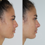 Source: Dr. Moubayed’s practice. Not a guarantee of results. Photos published with informed written consent of patients Female treated with non surgical nose job