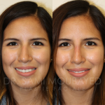 Source: Dr. Moubayed’s practice. Not a guarantee of results. Photos published with informed written consent of patients Female treated with non surgical nose job
