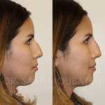 Source: Dr. Moubayed’s practice. Not a guarantee of results. Photos published with informed written consent of patients Female treated with non surgical nose job