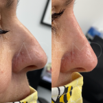 Source: Dr. Moubayed’s practice. Not a guarantee of results. Photos published with informed written consent of patients Female treated with non surgical nose job