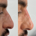 Source: Dr. Moubayed’s practice. Not a guarantee of results. Photos published with informed written consent of patients Male treated with non surgical nose job