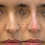 Source: Dr. Moubayed’s practice. Not a guarantee of results. Photos published with informed written consent of patients Female treated with non surgical nose job