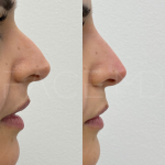 Source: Dr. Moubayed’s practice. Not a guarantee of results. Photos published with informed written consent of patients Female treated with non surgical nose job