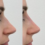 Source: Dr. Moubayed’s practice. Not a guarantee of results. Photos published with informed written consent of patients Female treated with non surgical nose job
