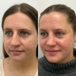 Beautiful result just under 1 year after rhinoplasty and alar base reduction.