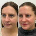 Beautiful result just under 1 year after rhinoplasty and alar base reduction.