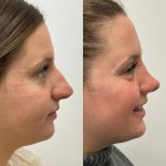 Beautiful result just under 1 year after rhinoplasty and alar base reduction.