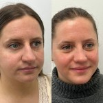 Beautiful result just under 1 year after rhinoplasty and alar base reduction.