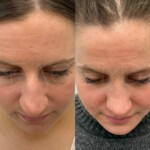 Beautiful result just under 1 year after rhinoplasty and alar base reduction.