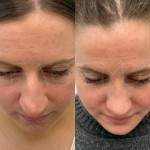 Beautiful result just under 1 year after rhinoplasty and alar base reduction.