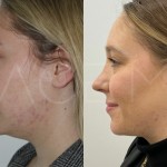 Source: Dr. Moubayed’s practice. Not a guarantee of results. Photos published with informed written consent of patients Female treated with chin liposuction and FaceTite