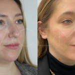 Source: Dr. Moubayed’s practice. Not a guarantee of results. Photos published with informed written consent of patients Female treated with chin liposuction and FaceTite