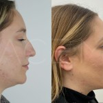Source: Dr. Moubayed’s practice. Not a guarantee of results. Photos published with informed written consent of patients Female treated with chin liposuction and FaceTite