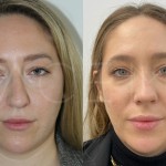 Source: Dr. Moubayed’s practice. Not a guarantee of results. Photos published with informed written consent of patients Female treated with chin liposuction and FaceTite