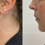 Source: Dr. Moubayed’s practice. Not a guarantee of results. Photos published with informed written consent of patients Female treated with chin liposuction and FaceTite