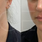 Source: Dr. Moubayed’s practice. Not a guarantee of results. Photos published with informed written consent of patients Female treated with chin liposuction and FaceTite