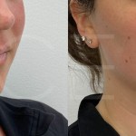 Source: Dr. Moubayed’s practice. Not a guarantee of results. Photos published with informed written consent of patients