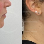 Source: Dr. Moubayed’s practice. Not a guarantee of results. Photos published with informed written consent of patients Female treated with chin liposuction and FaceTite