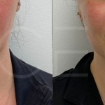 Source: Dr. Moubayed’s practice. Not a guarantee of results. Photos published with informed written consent of patients Female treated with chin liposuction and FaceTite