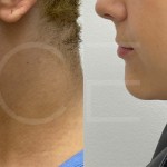 Source: Dr. Moubayed’s practice. Not a guarantee of results. Photos published with informed written consent of patients Female treated with chin liposuction in Montreal