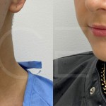 Source: Dr. Moubayed’s practice. Not a guarantee of results. Photos published with informed written consent of patients Female treated with chin liposuction in Montreal