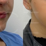 Source: Dr. Moubayed’s practice. Not a guarantee of results. Photos published with informed written consent of patients Female treated with chin liposuction in Montreal