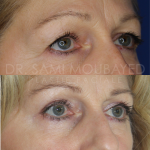 Source: Dr. Moubayed’s practice. Not a guarantee of results. Photos published with informed written consent of patients Female treated with upper blepharoplasty in Montreal