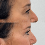 Source: Dr. Moubayed’s practice. Not a guarantee of results. Photos published with informed written consent of patients