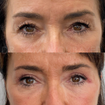 Source: Dr. Moubayed’s practice. Not a guarantee of results. Photos published with informed written consent of patients Female treated with upper blepharoplasty in Montreal