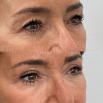 Source: Dr. Moubayed’s practice. Not a guarantee of results. Photos published with informed written consent of patients Female treated with upper blepharoplasty in Montreal