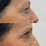 Source: Dr. Moubayed’s practice. Not a guarantee of results. Photos published with informed written consent of patients Female treated with upper blepharoplasty in Montreal