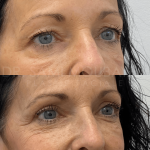 Source: Dr. Moubayed’s practice. Not a guarantee of results. Photos published with informed written consent of patients Female treated with upper blepharoplasty in Montreal