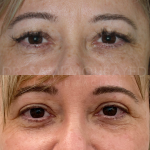 Source: Dr. Moubayed’s practice. Not a guarantee of results. Photos published with informed written consent of patients Female treated with upper blepharoplasty in Montreal