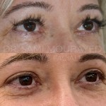 Source: Dr. Moubayed’s practice. Not a guarantee of results. Photos published with informed written consent of patients Female treated with upper blepharoplasty in Montreal