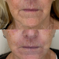 2 Months After 1 treatment of CO2 Laser and a Deep Plane Face & Neck Lift